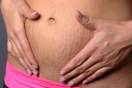 Schwangerschaftsstreifen oder Dehnungsstreifen entstehen, wenn die Haut stark gedehnt wird.