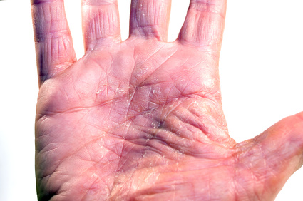 Geschwächte Haut führt gemäss Dermatologen zu einem Handekzem