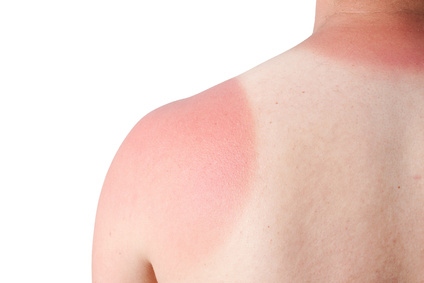 Der Dermatologe erkennt Sonnenbrand an Rötung, Schwellung, Blasenbildung